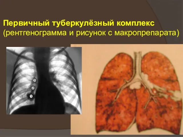Первичный туберкулёзный комплекс (рентгенограмма и рисунок с макропрепарата)