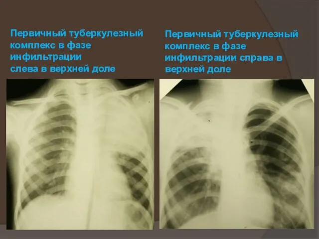 Первичный туберкулезный комплекс в фазе инфильтрации слева в верхней доле