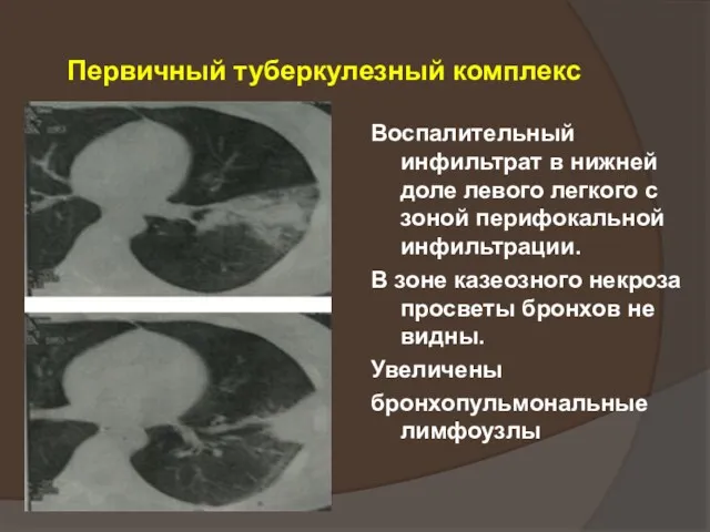 Первичный туберкулезный комплекс Воспалительный инфильтрат в нижней доле левого легкого