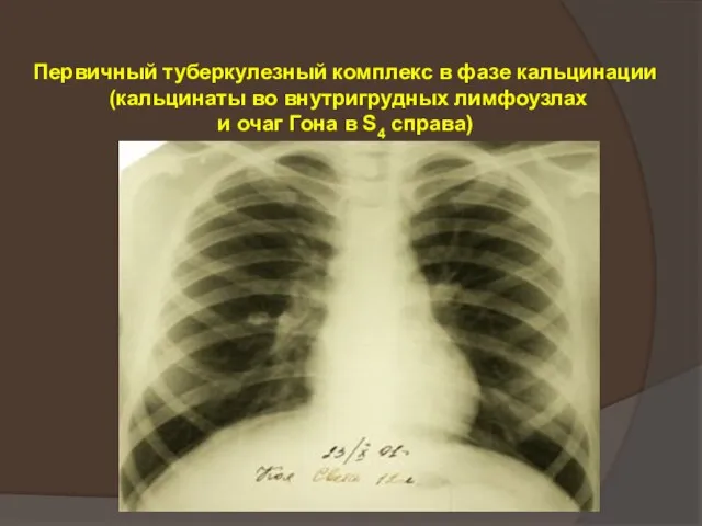 Первичный туберкулезный комплекс в фазе кальцинации (кальцинаты во внутригрудных лимфоузлах и очаг Гона в S4 справа)