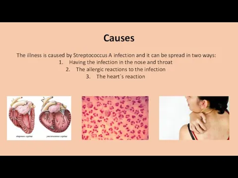 Causes The illness is caused by Streptococcus A infection and it can be