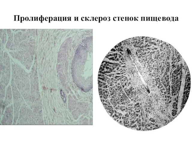 Пролиферация и склероз стенок пищевода