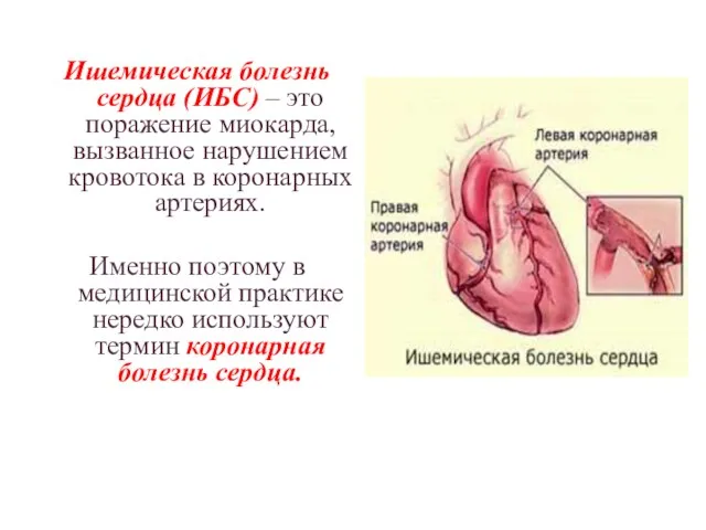 Ишемическая болезнь сердца (ИБС) – это поражение миокарда, вызванное нарушением