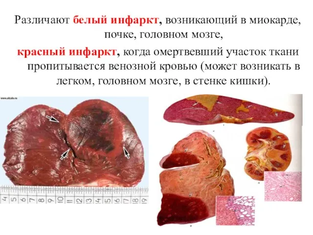 Различают белый инфаркт, возникающий в миокарде, почке, головном мозге, красный