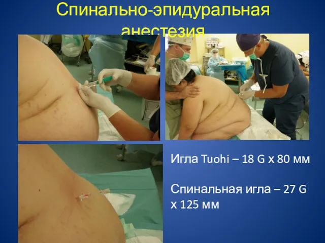 Спинально-эпидуральная анестезия Игла Tuohi – 18 G х 80 мм Спинальная игла –