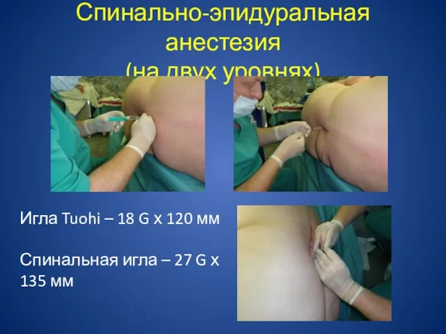 Спинально-эпидуральная анестезия (на двух уровнях) Игла Tuohi – 18 G х 120 мм