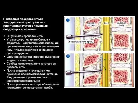 Попадание просвета иглы в эпидуральное пространство идентифицируется с помощью следующих