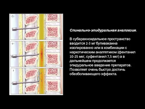 Спинально-эпидуральная аналгезия. В субарахноидальное пространство вводится 2-3 мг бупивакаина изолированно