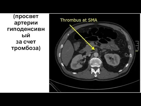 Тромбоз ВБА (просвет артерии гиподенсивный за счет тромбоза)