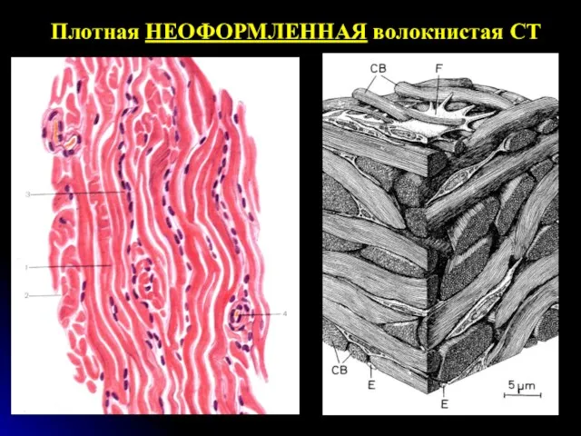 Плотная НЕОФОРМЛЕННАЯ волокнистая СТ