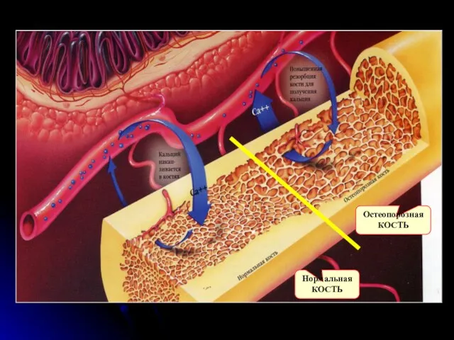 Нормальная КОСТЬ Остеопорозная КОСТЬ