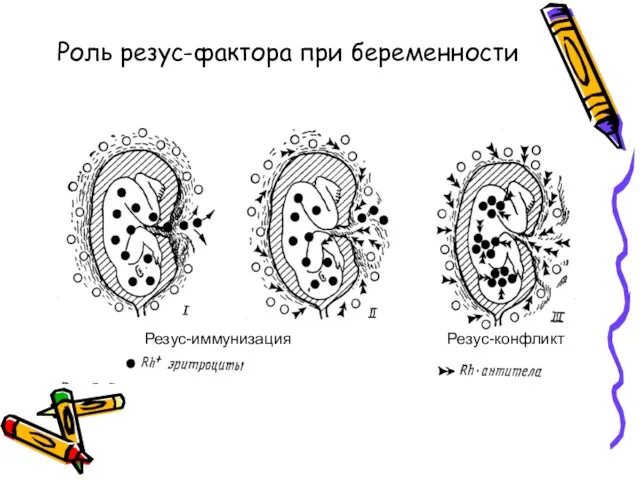 Роль резус-фактора при беременности Резус-иммунизация Резус-конфликт