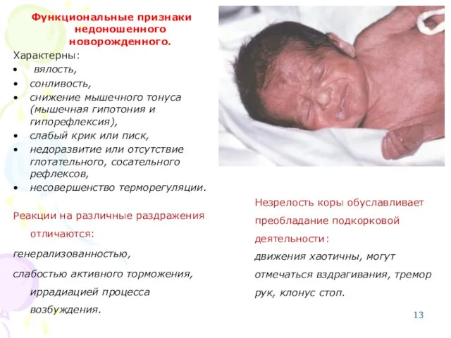 Функциональные признаки недоношенного новорожденного. Характерны: вялость, сонливость, снижение мышечного тонуса