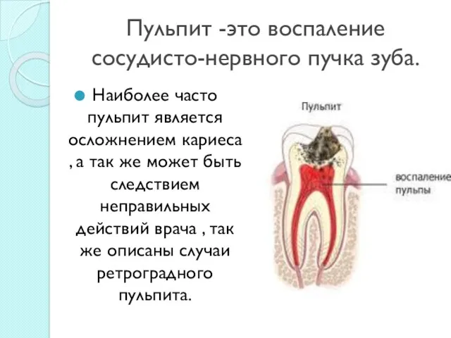 Пульпит -это воспаление сосудисто-нервного пучка зуба. Наиболее часто пульпит является осложнением кариеса ,