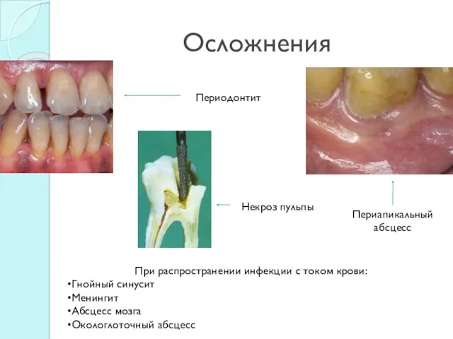 Осложнения Периодонтит Некроз пульпы Периапикальный абсцесс При распространении инфекции с током крови: Гнойный