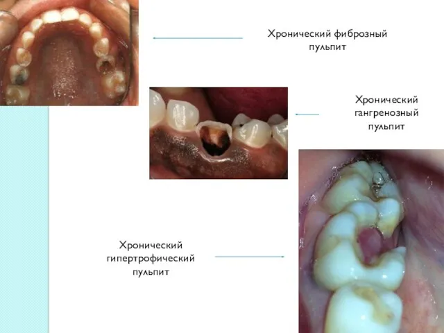 Хронический фиброзный пульпит Хронический гангренозный пульпит Хронический гипертрофический пульпит