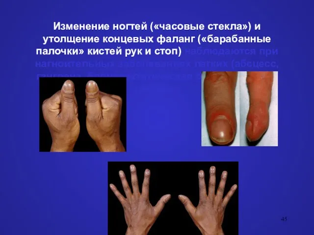Изменение ногтей («часовые стекла») и утолщение концевых фаланг («барабанные палочки» кистей рук и