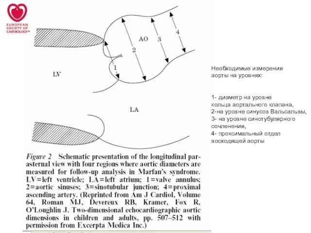 Необходимые измерения аорты на уровнях: 1- диаметр на уровне кольца