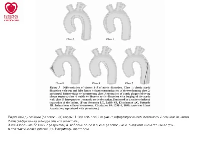 Варианты диссекции (расслоения) аорты: 1- классический вариант с формированием истинного