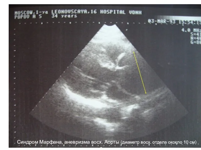 Синдром Марфана, аневризма восх. Аорты (диаметр восх. отдела ококло 10 см)