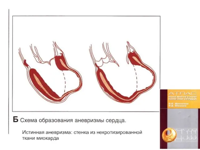 Истинная аневризма: стенка из некротизированной ткани миокарда