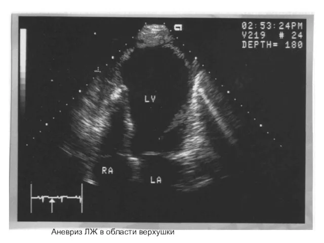 Аневриз ЛЖ в области верхушки