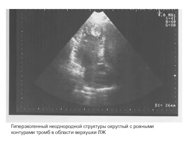 Гиперэхогенный неоднородной структуры округлый с ровными контурами тромб в области верхушки ЛЖ