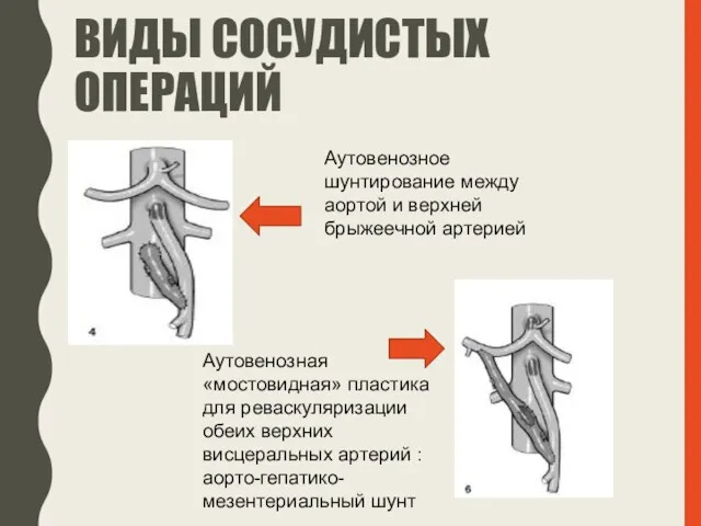 ВИДЫ СОСУДИСТЫХ ОПЕРАЦИЙ Аутовенозное шунтирование между аортой и верхней брыжеечной