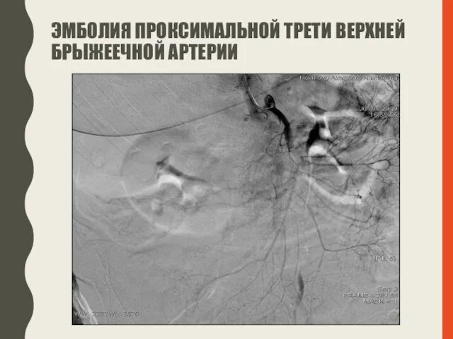 ЭМБОЛИЯ ПРОКСИМАЛЬНОЙ ТРЕТИ ВЕРХНЕЙ БРЫЖЕЕЧНОЙ АРТЕРИИ