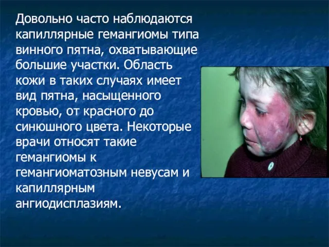 Довольно часто наблюдаются капиллярные гемангиомы типа винного пятна, охватывающие большие