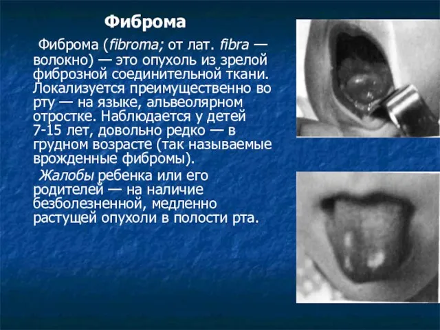 Фиброма Фиброма (fibroma; от лат. fibra — волокно) — это