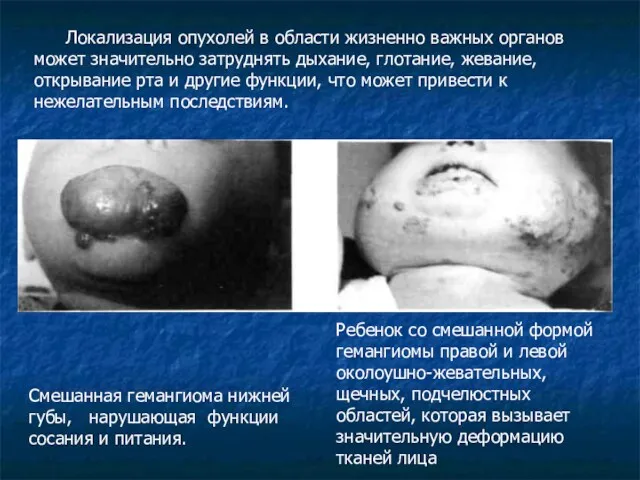 Смешанная гемангиома нижней губы, нарушающая функции сосания и питания. Ребенок