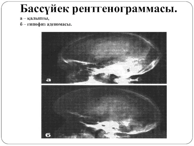 Бассүйек рентгенограммасы. а – қалыпты, б – гипофиз аденомасы.