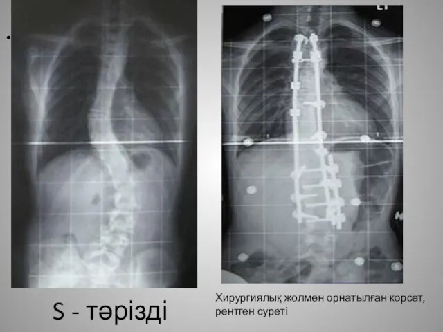 S - тәрізді S - тәрізді Хирургиялық жолмен орнатылған корсет, рентген суреті