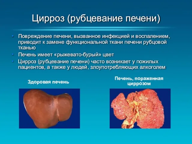 Цирроз (рубцевание печени) Повреждение печени, вызванное инфекцией и воспалением, приводит