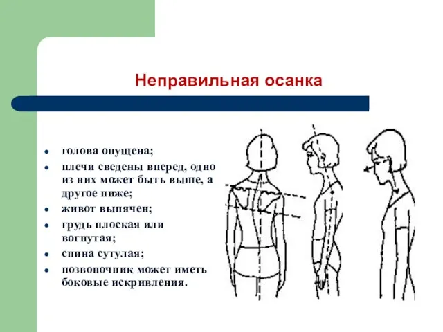 Неправильная осанка голова опущена; плечи сведены вперед, одно из них