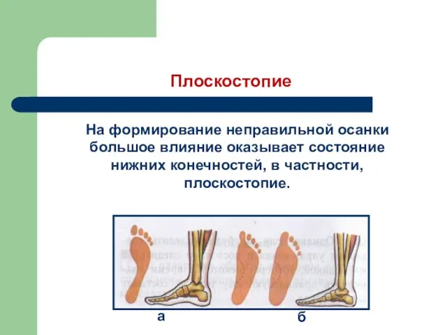 Плоскостопие На формирование неправильной осанки большое влияние оказывает состояние нижних конечностей, в частности, плоскостопие. а б