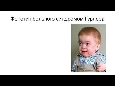 Фенотип больного синдромом Гурлера