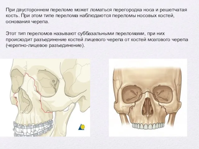 При двустороннем переломе может ломаться перегородка носа и решетчатая кость.