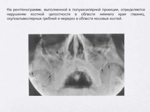 На рентгенограмме, выполненной в полуаксилярной проекции, определяется нарушение костной целостности