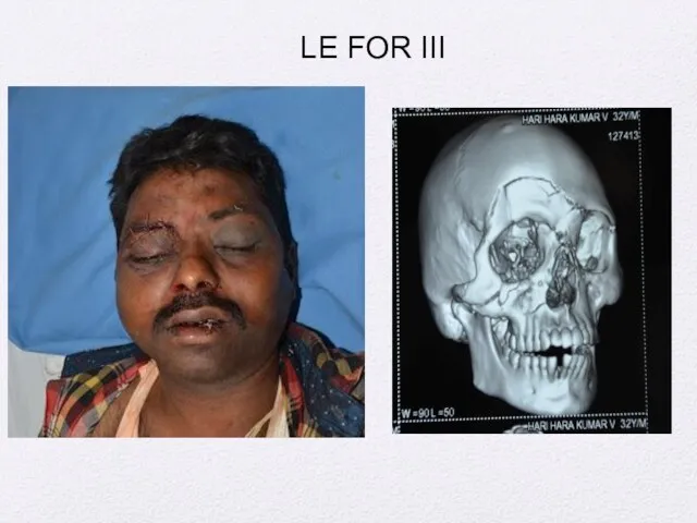 LE FOR III