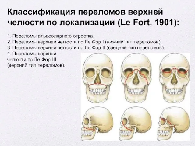 Классификация переломов верхней челюсти по локализации (Le Fort, 1901): 1.