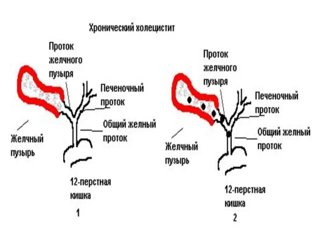 ҚОРЫТЫНДЫ: Алты ай бойы өт қуығы алынған науқастар дәрігердің бақылауында