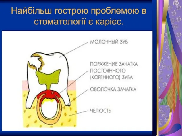 Найбільш гострою проблемою в стоматології є карієс.