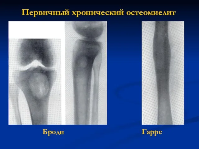 Первичный хронический остеомиелит Броди Гарре