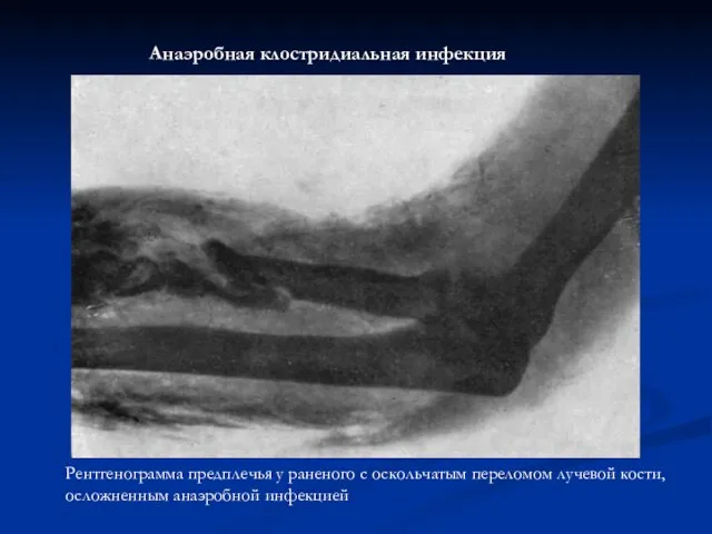 Рентгенограмма предплечья у раненого с оскольчатым переломом лучевой кости, осложненным анаэробной инфекцией Анаэробная клостридиальная инфекция