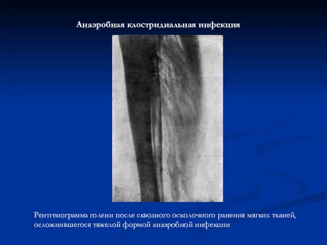 Рентгенограмма голени после сквозного осколочного ранения мягких тканей, осложнившегося тяжелой формой анаэробной инфекции Анаэробная клостридиальная инфекция