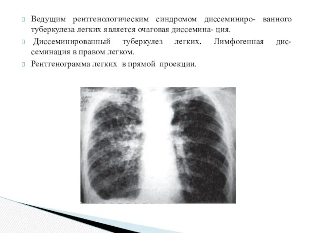 Ведущим рентгенологическим синдромом диссеминиро- ванного туберкулеза легких является очаговая диссемина-