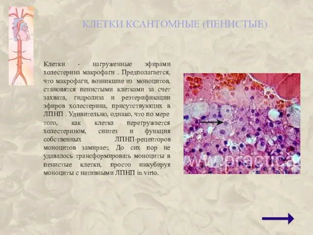 КЛЕТКИ КСАНТОМНЫЕ (ПЕНИСТЫЕ) Клетки - нагруженные эфирами холестерина макрофаги .
