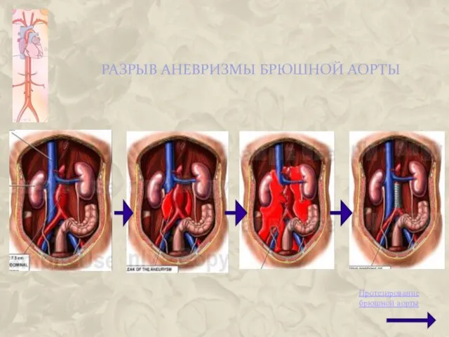 РАЗРЫВ АНЕВРИЗМЫ БРЮШНОЙ АОРТЫ Протезирование брюшной аорты